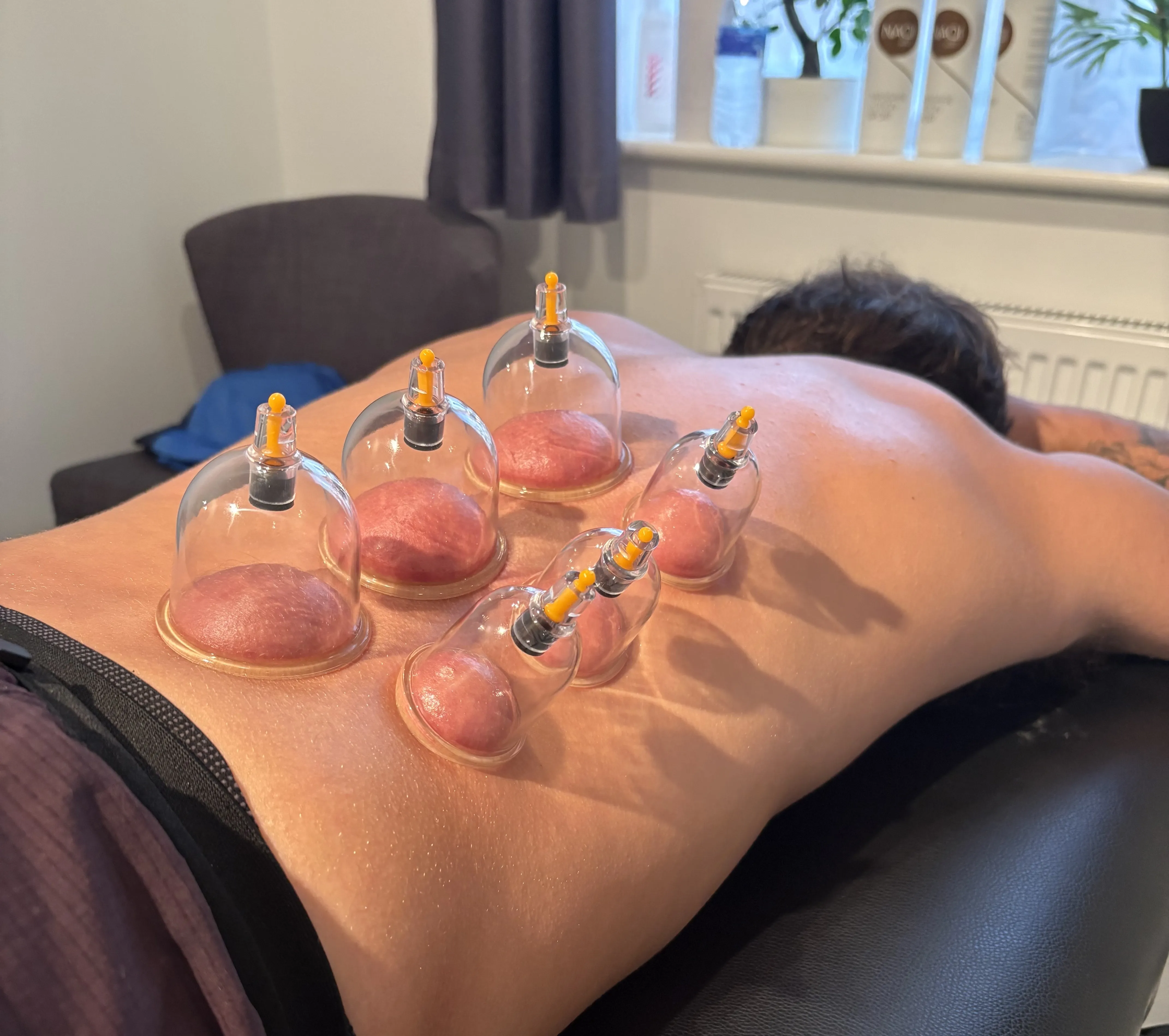 A sports massage and cupping treatment